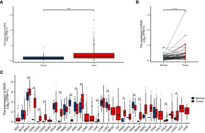 IRX5’s influence on macrophage polarization and outcome in papillary thyroid cancer